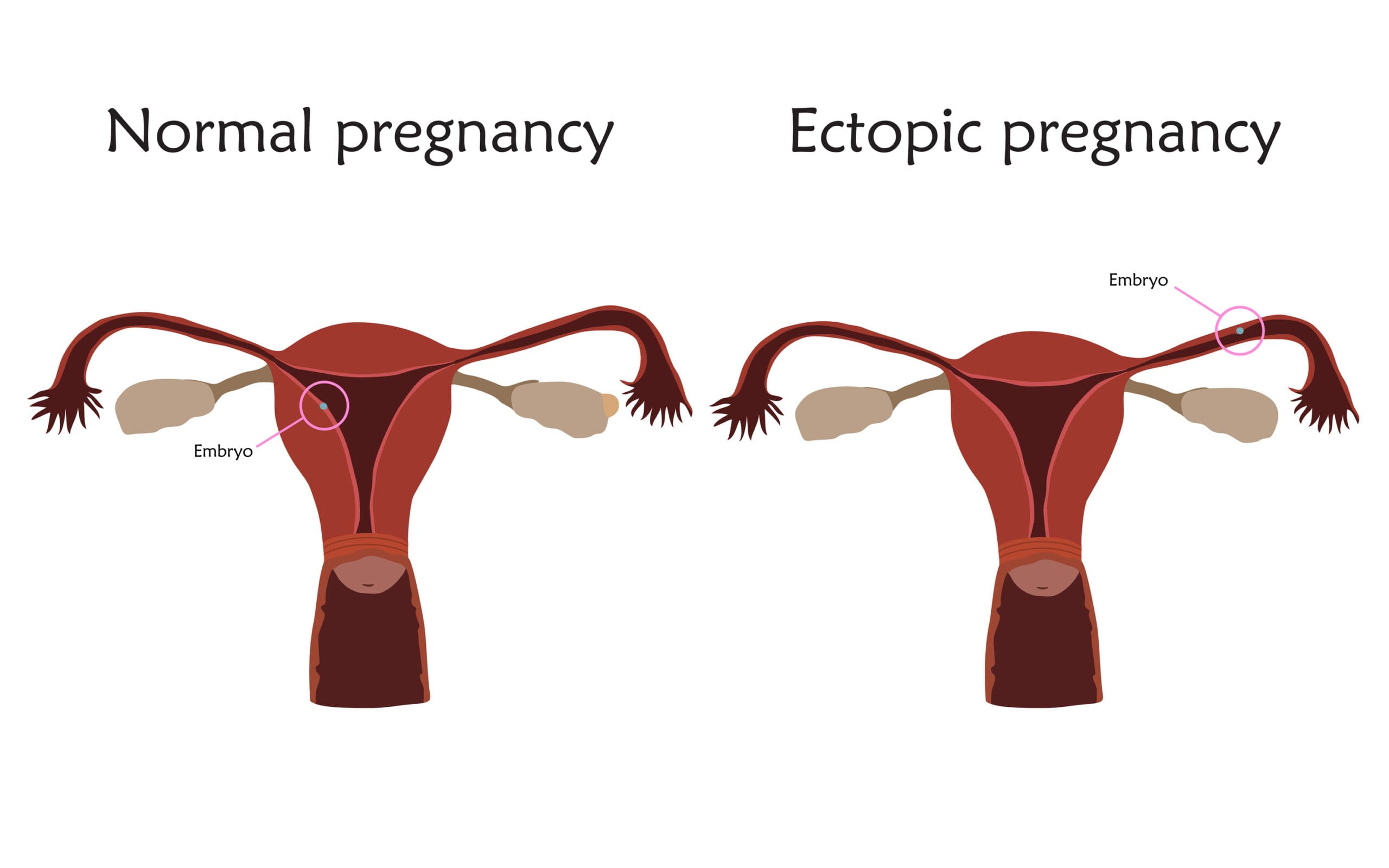 normal vs ectopic pregnancy normal vs ectopic pregnancy